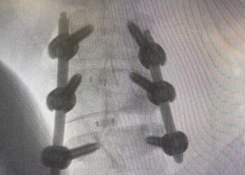 老婦下背痛腳麻 脊椎微創內視鏡手術助改善