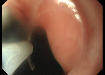 魚刺卡喉 內視鏡+小工具成功取出